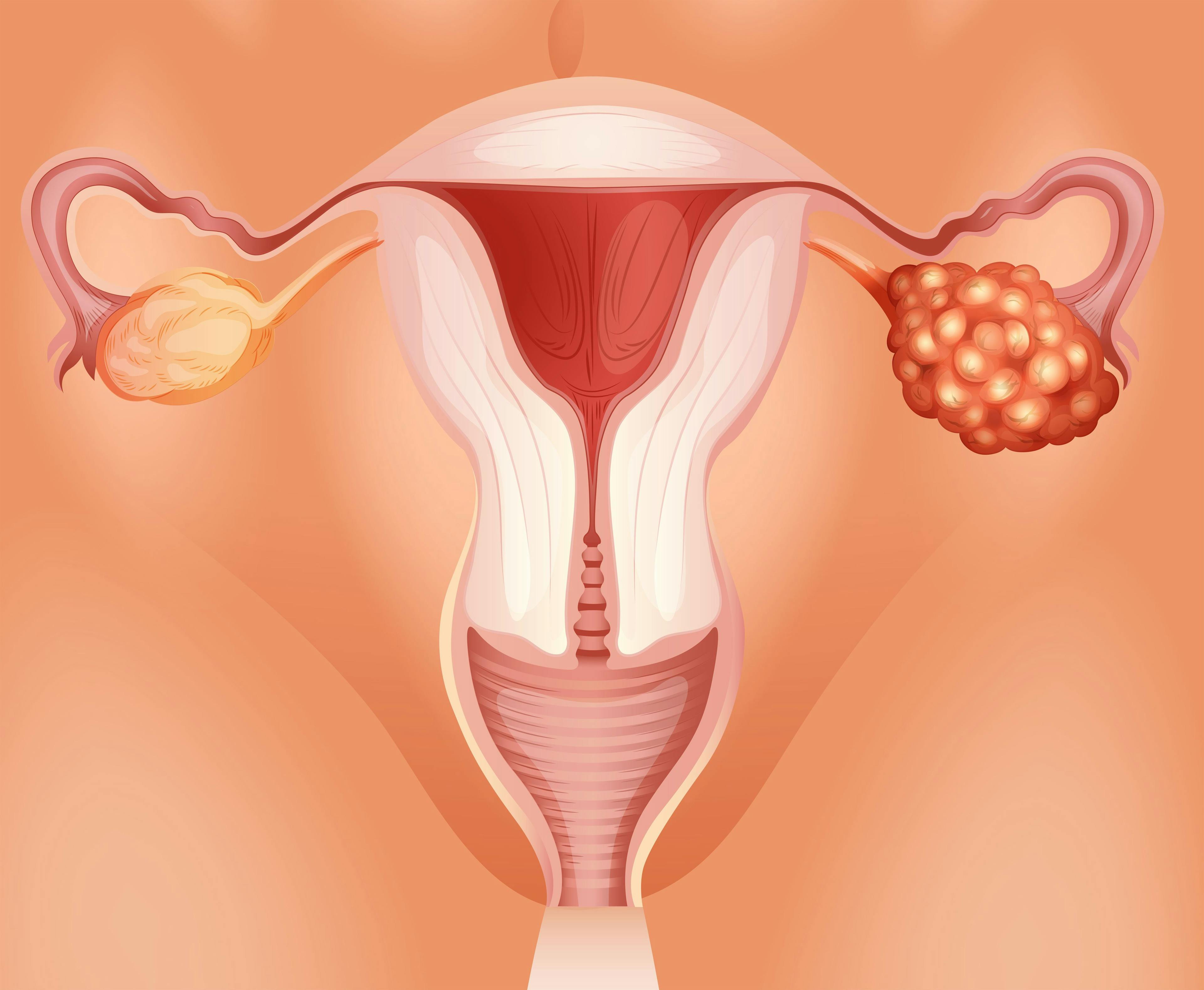 Azenosertib治疗高级别浆液性卵巢癌的疗效