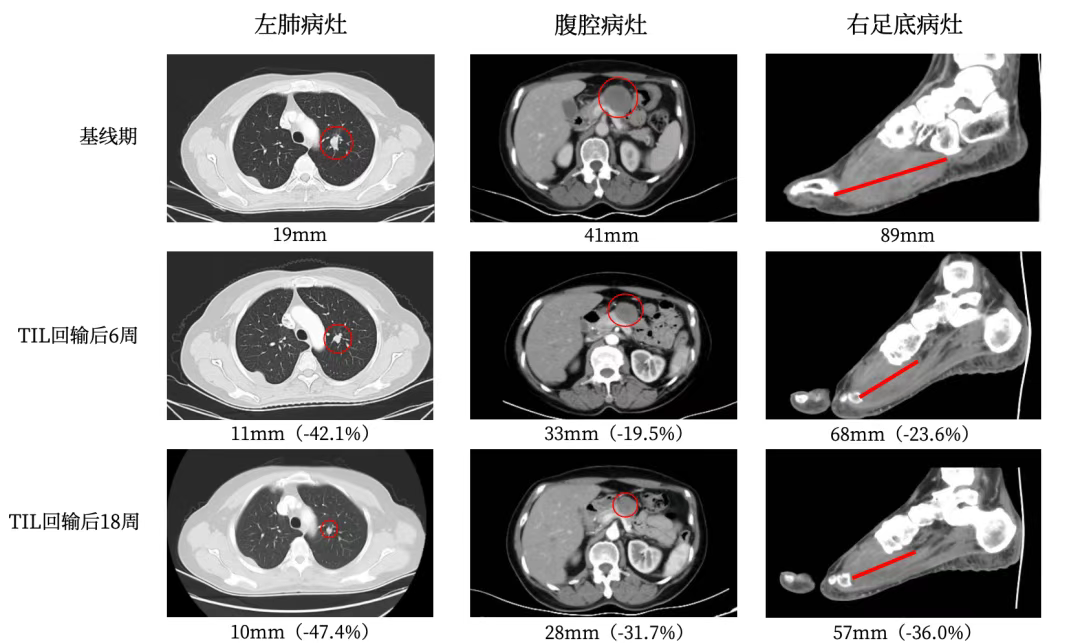 GC101 TIL疗法实现黑色素瘤患者部分缓解
