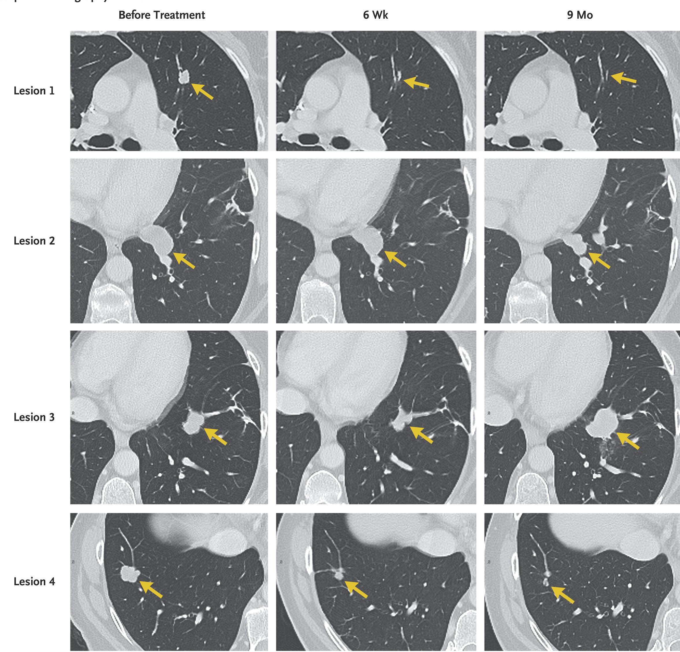 靶向KRAS G12D的T细胞治疗结直肠癌，所有七个转移性肺病灶均已消退